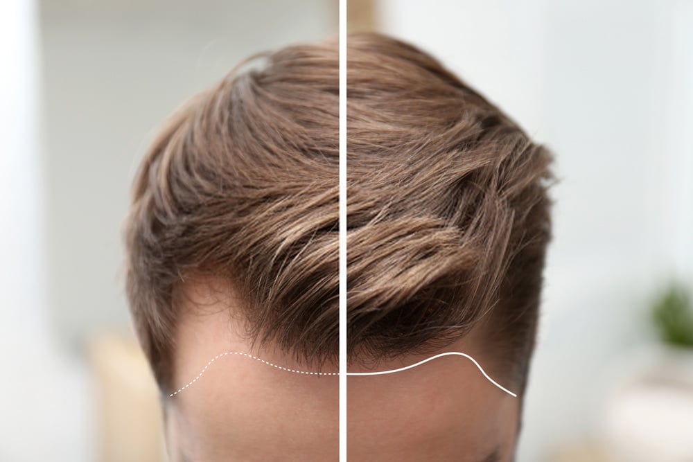 SAW PALMETTO: THE REVOLUTIONARY ANTI-HAIR LOSS MIRACLE 9 Anticaida saw palmetto 2